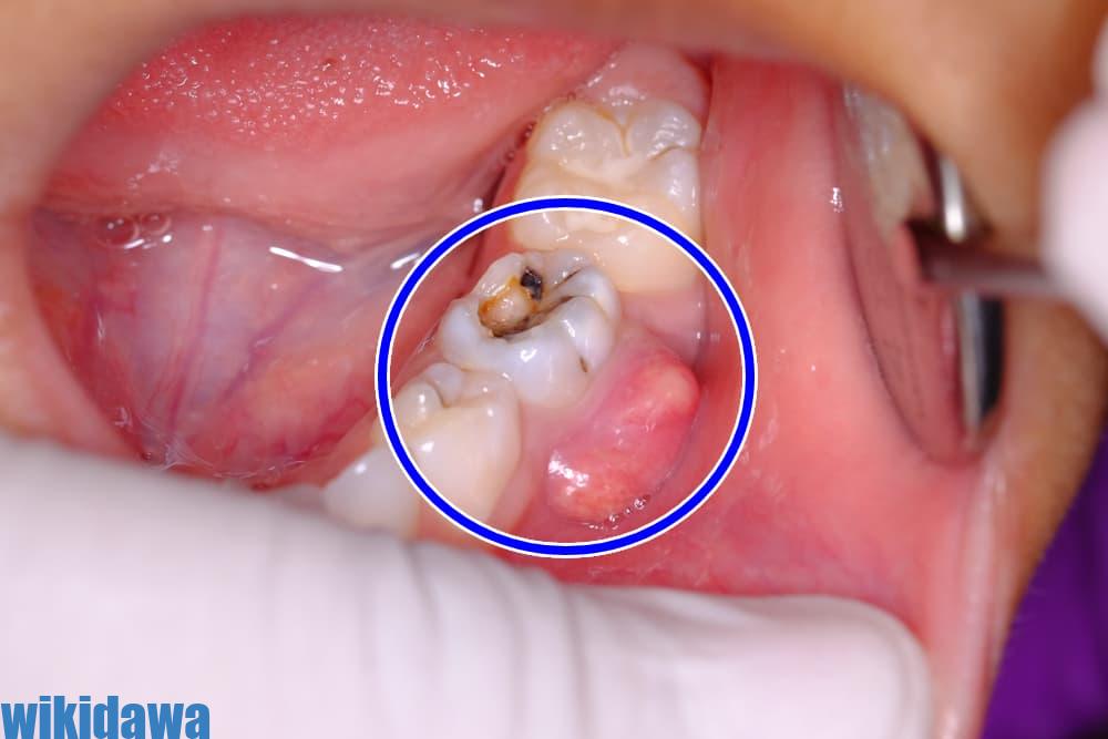 أسباب مشكلة خراج الأسنان