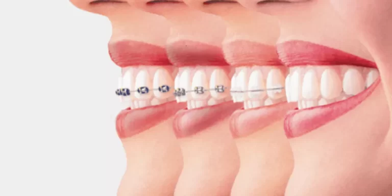 تقويم الأسنان وأهمية هذه العملية وأنواع التقويم للأسنان
