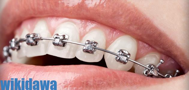 تقويم الأسنان وما هي أهم الأضرار والآثار الجانبية لعملية تقويم الأسنان