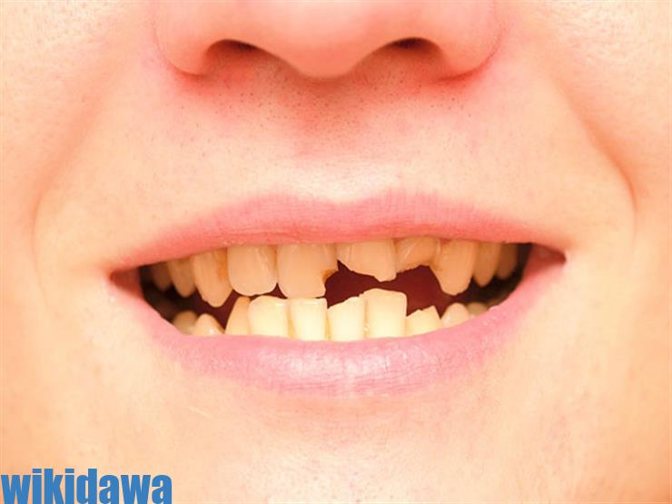 ما هي أسباب حدوث مشكلة تصدع الأسنان وطرق علاج هذه المشكلة
