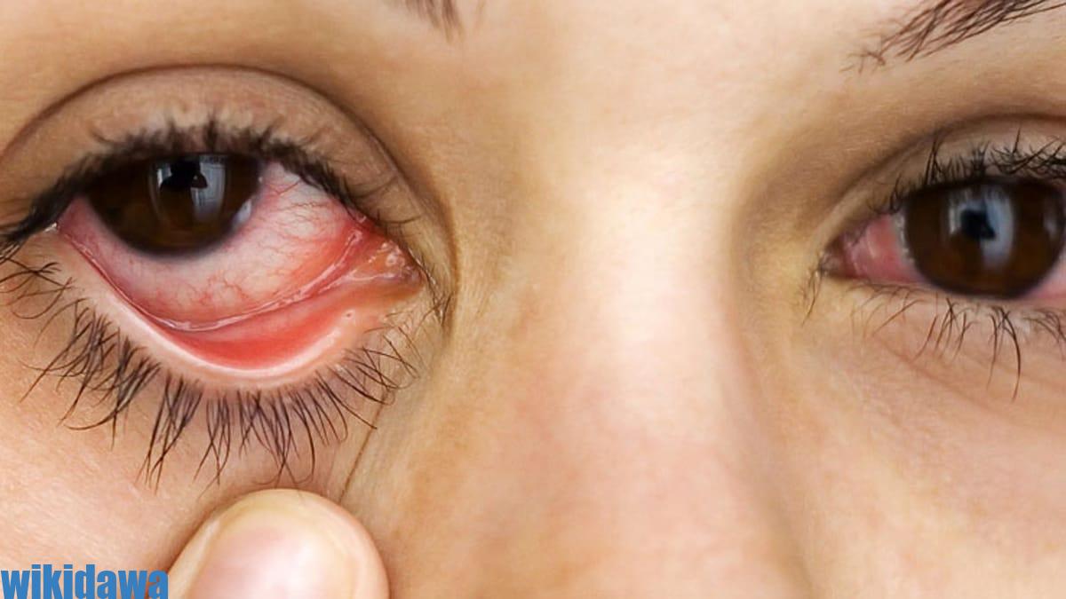 أعراض جفاف العين