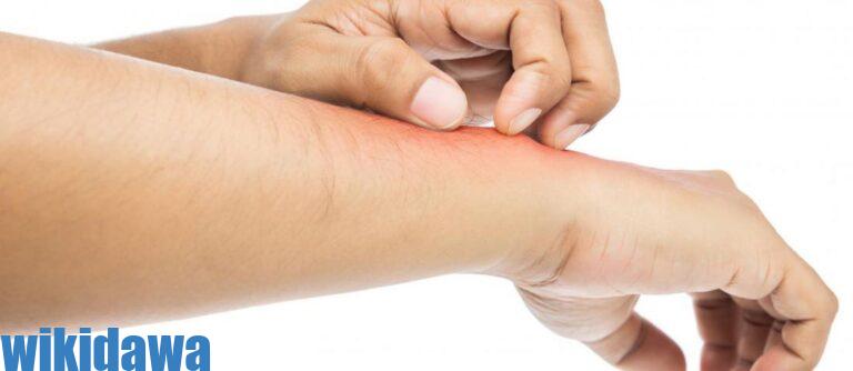 طرق علاج حساسية الجلد في المنزل